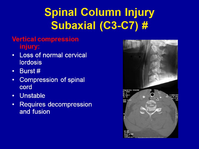 Spinal Column Injury Subaxial (C3-C7) # Vertical compression injury: Loss of normal cervical lordosis